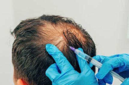 Mesotherapy for Hair